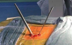 ��Ƶ΢�����ں�׵��׾�����UBE��ôѡ��