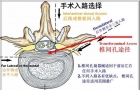 经椎间孔内窥镜下腰椎间盘摘除术和经皮内窥镜下腰椎间盘摘除术