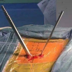 ��Ƶ΢�����ں�׵��׾�����UBE��ôѡ��